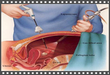 laparoscopia, intervento, diagnosi